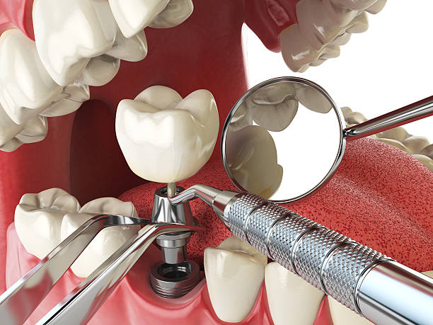 Best Emergency Treatment for Dental Infections or Abscesses in Simmesport, LA